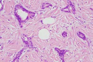 This medium power view allows critical evaluation of those structures forming tubules and those that are solid